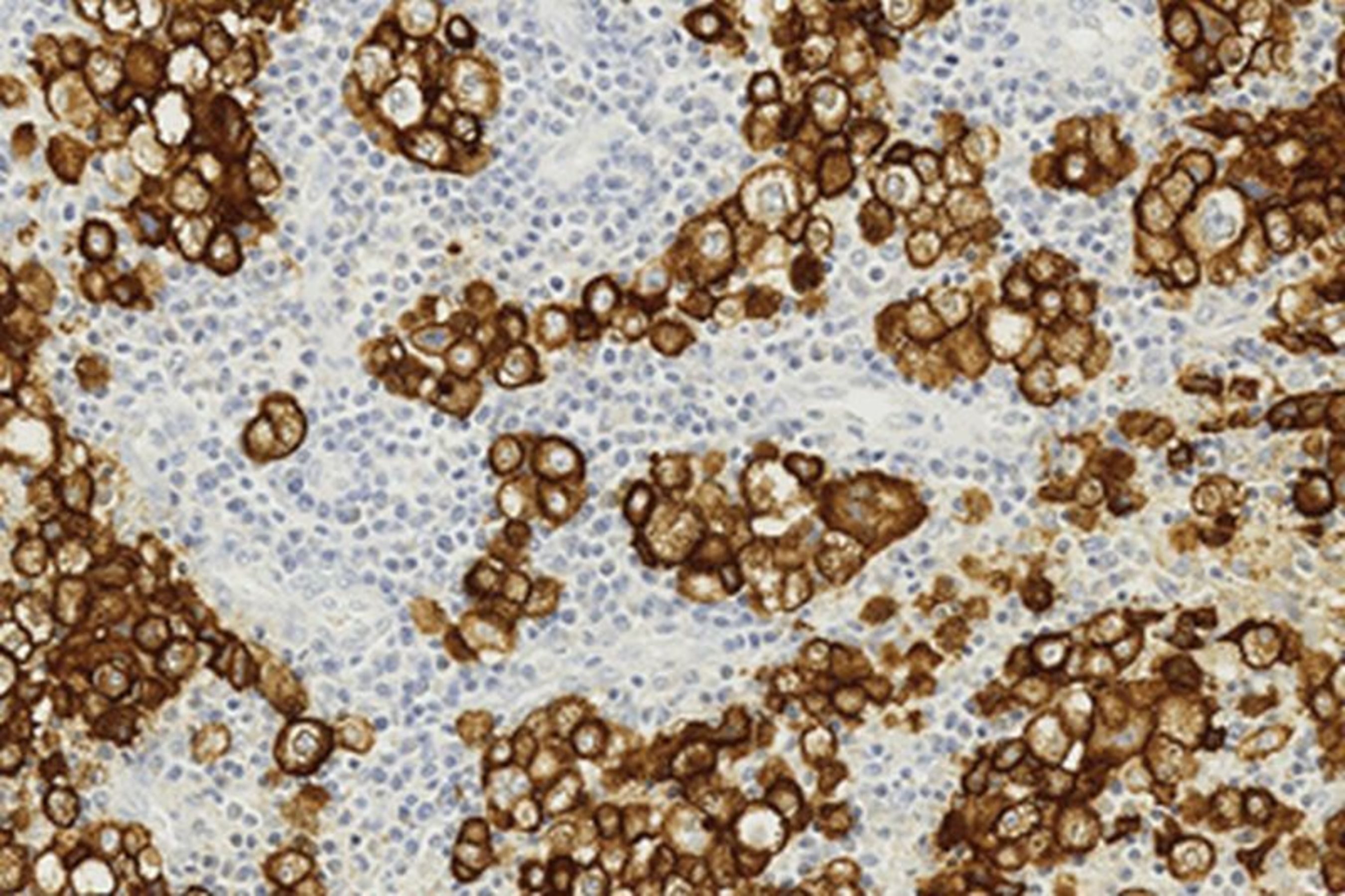 Human melanoma stained with Novocastra HD Melanoma Marker antibody, clone HMB45 (PRNewsFoto/Leica Biosystems)