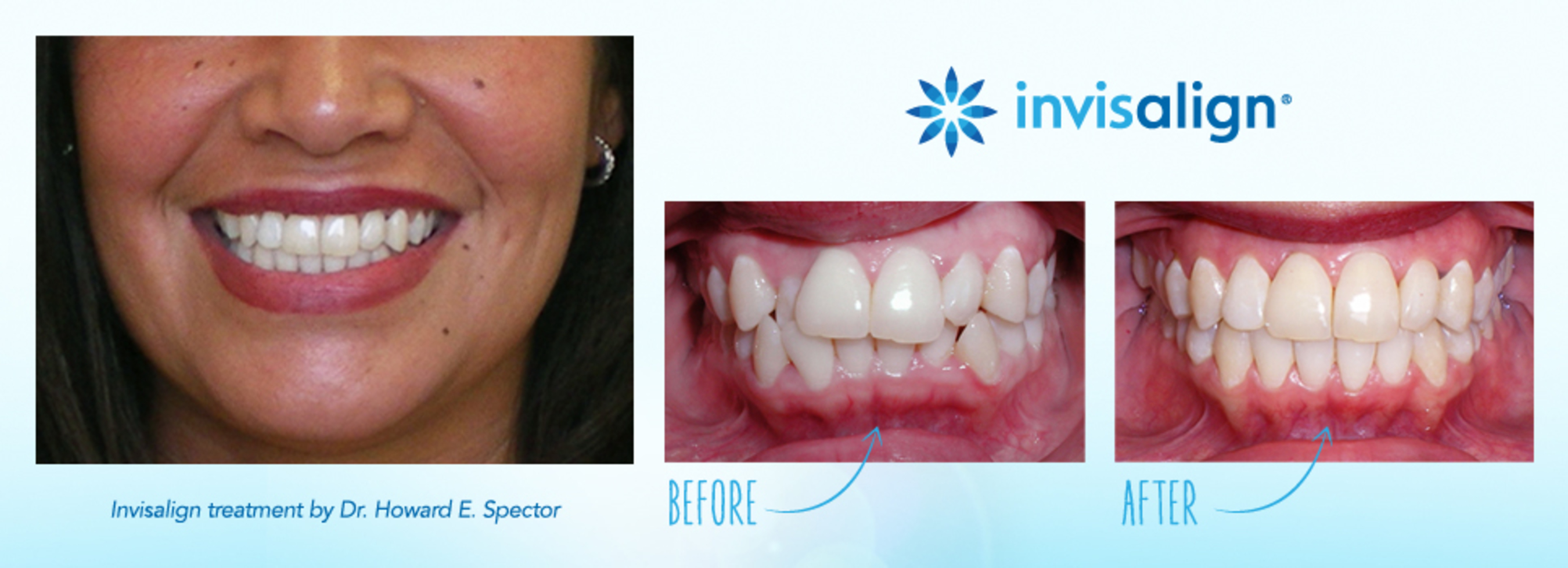 Invisalign treatment by Dr. Howard E. Spector - Treatment duration: 16 months - Disclaimer: The images are presented for reference purposes only and are not intended to represent the actual results a future Invisalign patient will achieve. Treatment times and results will vary by patient. (PRNewsFoto/Invisalign)