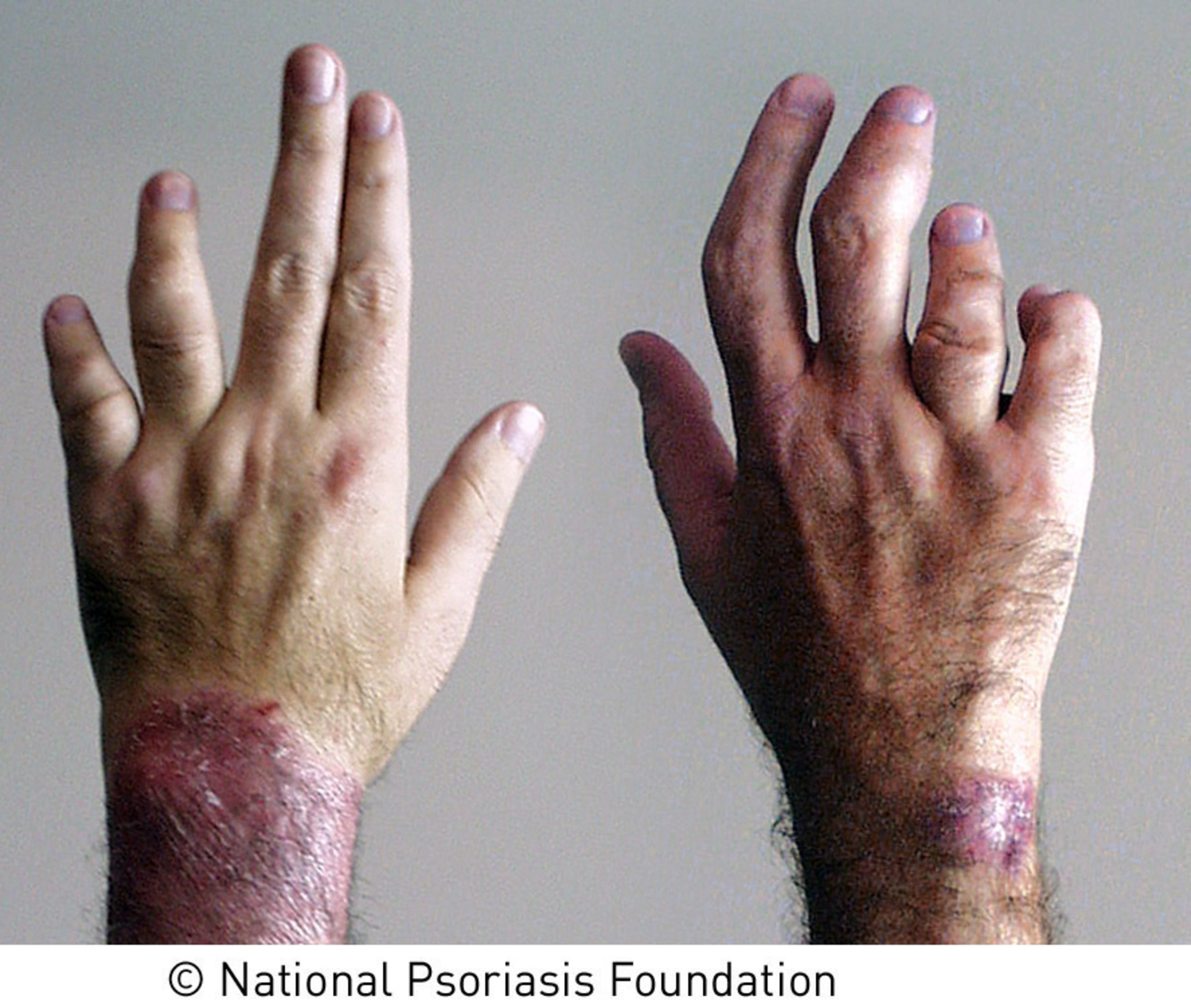 According to the National Psoriasis Foundation, psoriatic arthritis affects up to 30 percent of people with psoriasis. Symptoms of psoriatic arthritis include swollen, sausage-like fingers and toes, pain and swelling over the tendons, nail changes, and pain, swelling and stiffness in the joints. If left untreated, psoriatic arthritis can be disabling.   (PRNewsFoto/National Psoriasis Foundation)