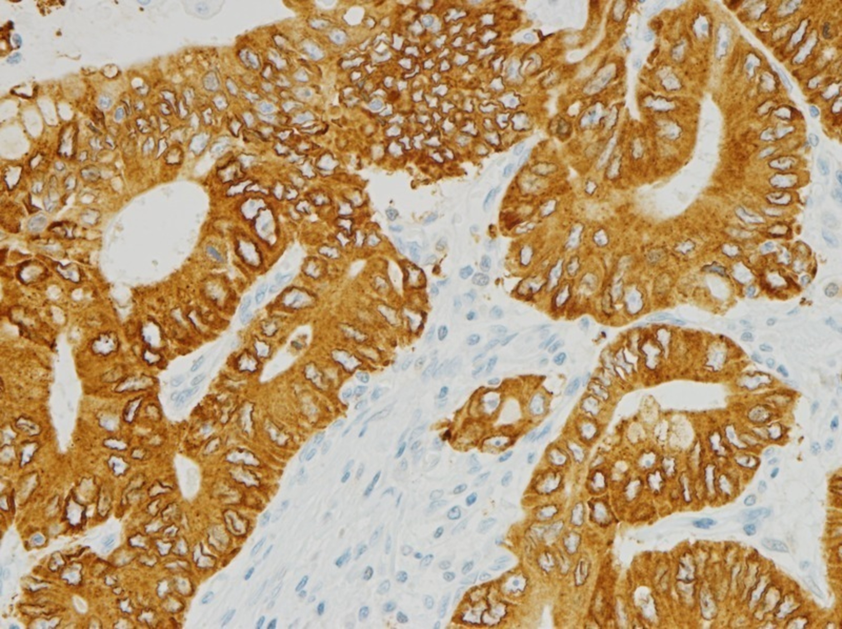 FGFR2 (fibroblast growth factor receptor 2) Gastric tissue at 20x stained on a VENTANA BenchMark XT (PRNewsFoto/Ventana Medical Systems, Inc.)