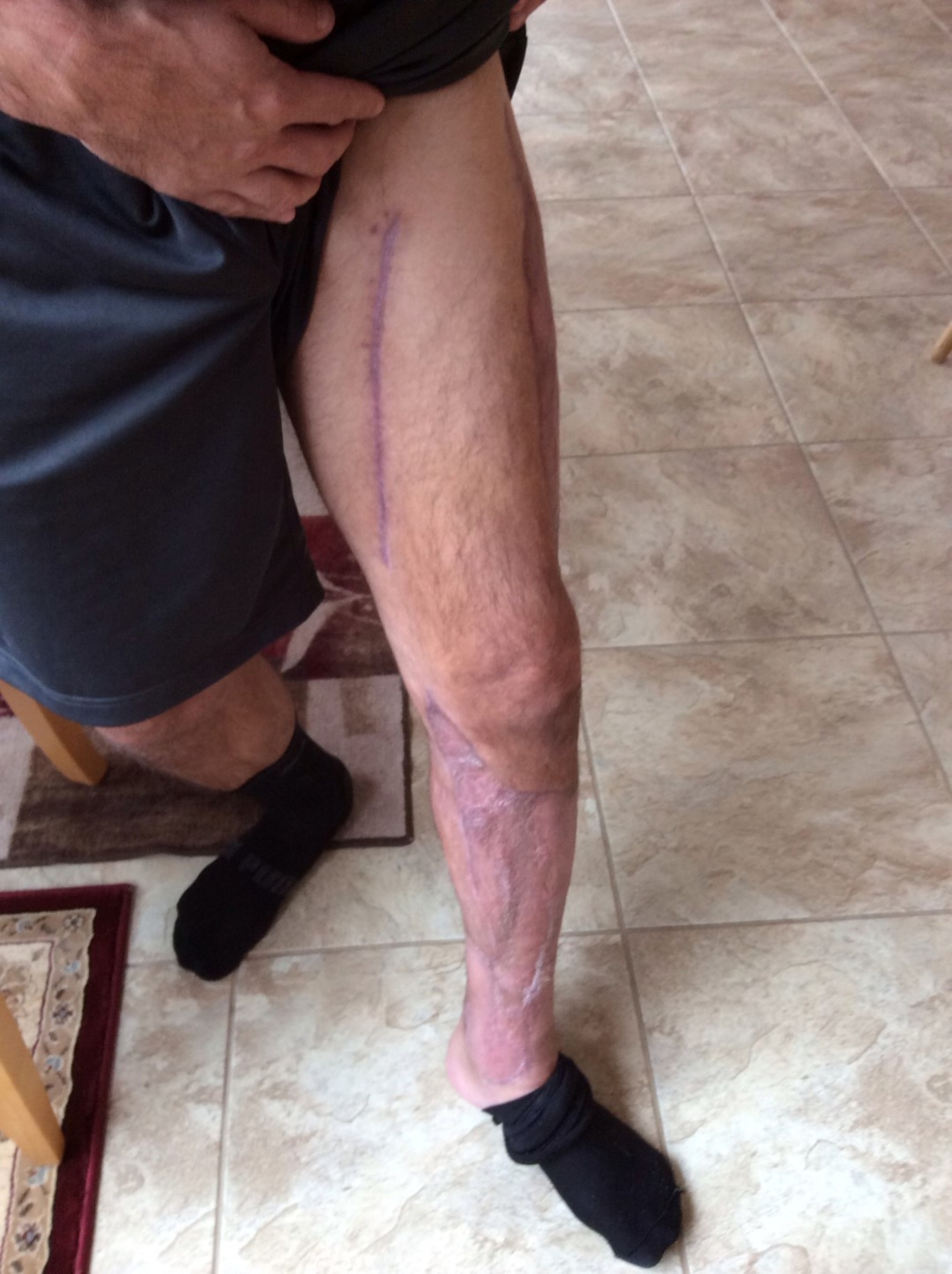 To save his leg, and potentially his life, his surgeon agreed to use the new Necrotizing Fasciitis Paradigm procedure.  This new approach involved radical debridement including the fascia, and stopping the progression of the disease with NeutroPhase(R) and the use of a vacuum assisted wound care system.  The final step in his recovery involved major skin grafting and after a total of three months Jared was healed and fully recovered (PRNewsFoto/NNFF)