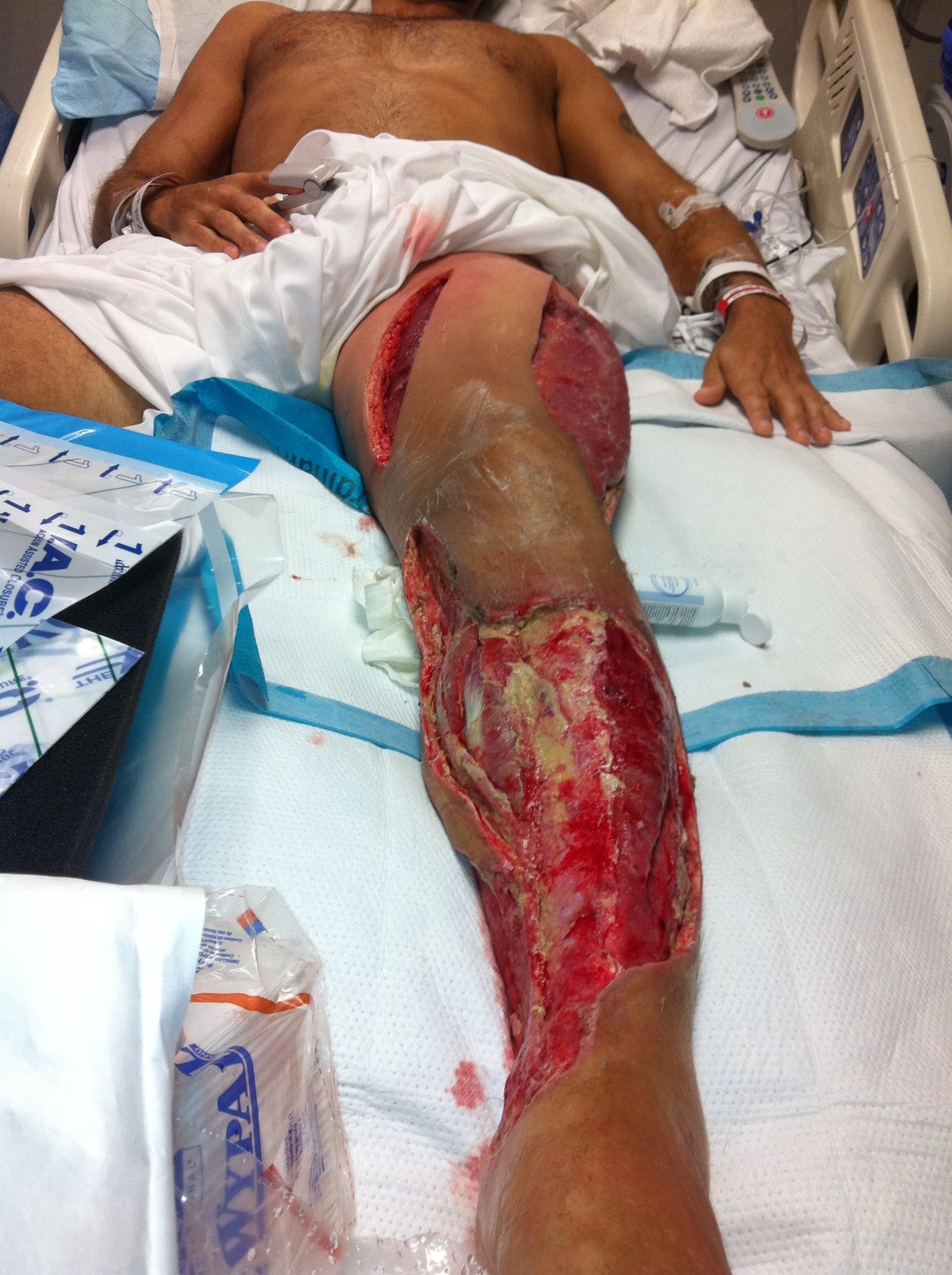 While swimming in the Pacific Ocean, off the Marshall Islands, Jared Hamilton cut his ankle on a piece of coral.  This simple injury soon progressed into a potentially life and limb threatening infection known as necrotizing fasciitis or “flesh eating disease.”  While the bacteria that caused the infection had been killed by antibiotics, the tissue destroying toxic proteins produced by the bacteria were unaffected and continued to migrate up his leg, destroying an ever increasing amount of tissue along the way.  It soon became apparent Jared needed to be transferred to Honolulu for advanced medical treatment. (PRNewsFoto/NNFF)