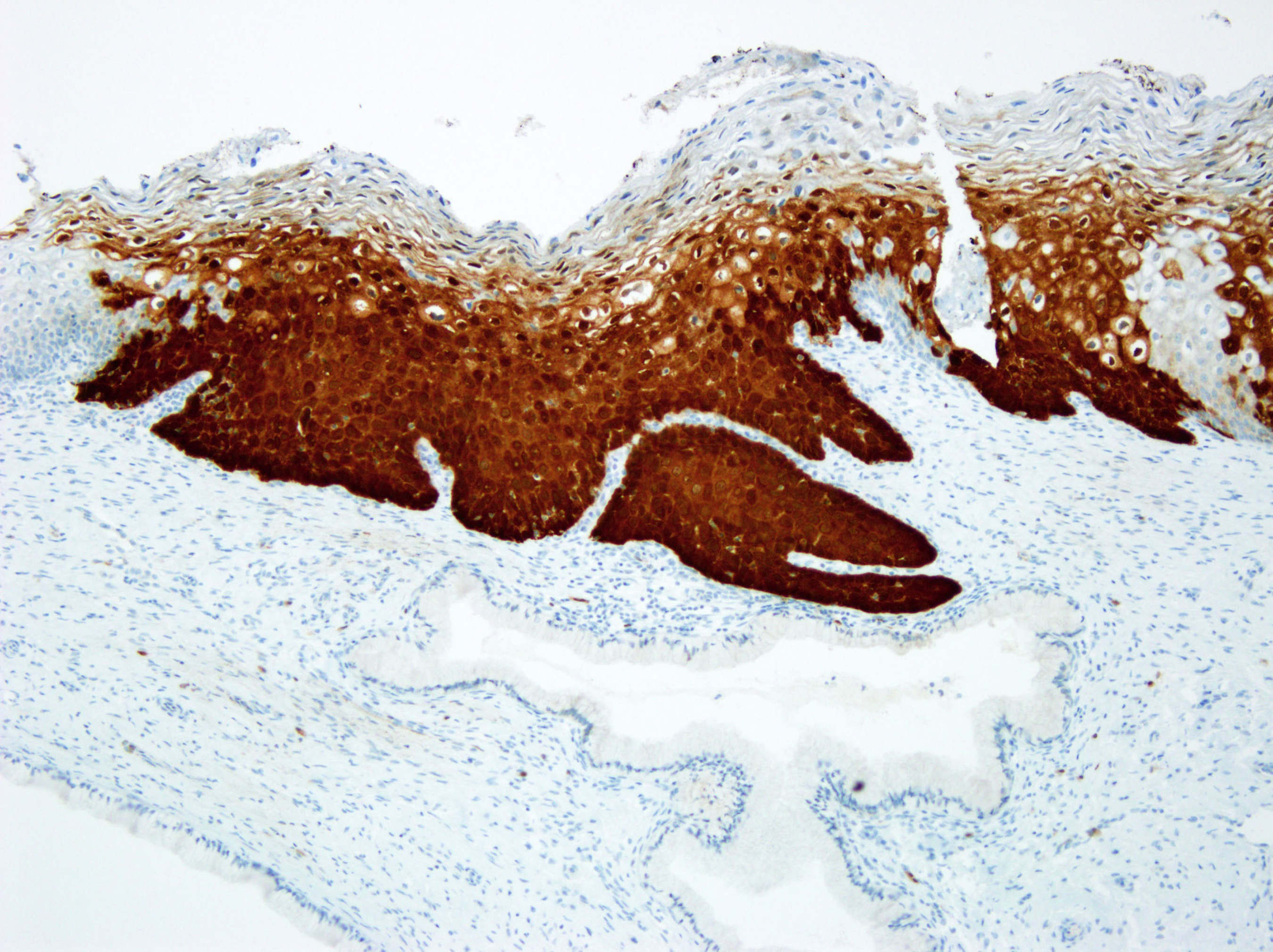 Cervical biopsy stained with the CINtec(R) p16 Histology test. The over-expression of the p16 biomarker in cervical specimens, detected by the CINtec(R) p16 Histology immunohistochemistry test, assists doctors in determining the presence or absence of high-grade cervical disease. (PRNewsFoto/Ventana Medical Systems, Inc.)