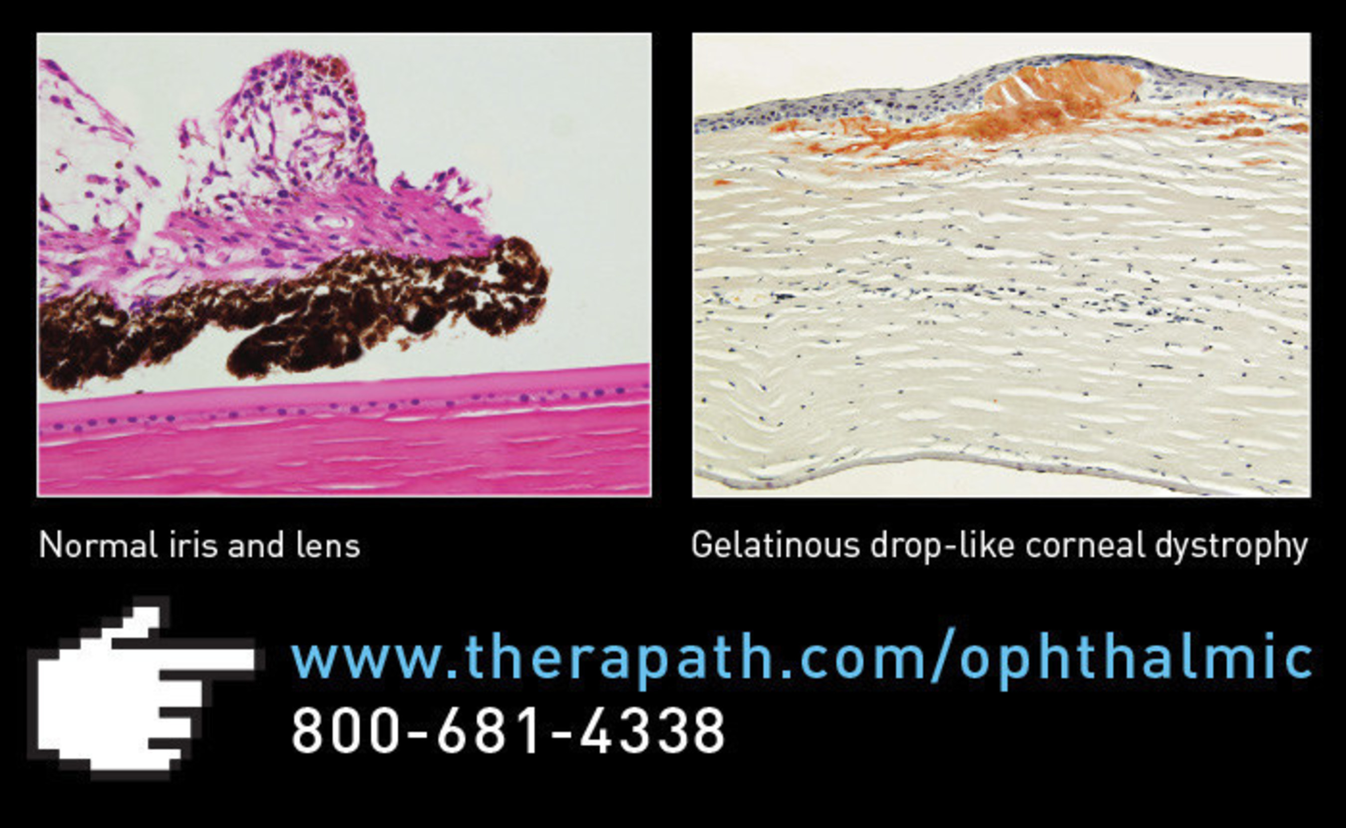 Therapath Neuropathology announces national Ophthalmic Pathology program