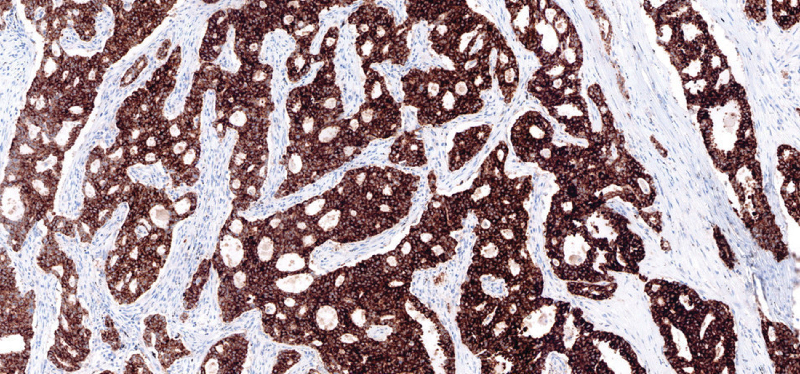 Positive case of lung tissue stained for ALK with VENTANA ALK (D5F3) CDx Assay
