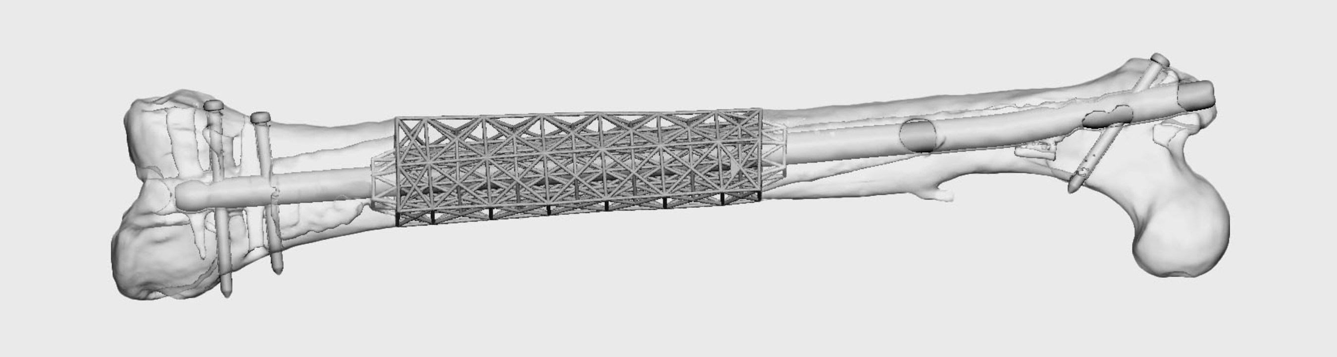 Structural engineering has been utilized for hundreds of years in bridges, roads and buildings. 4WEB utilizes structural engineering concepts such as truss design to produce innovative patient specific implants.