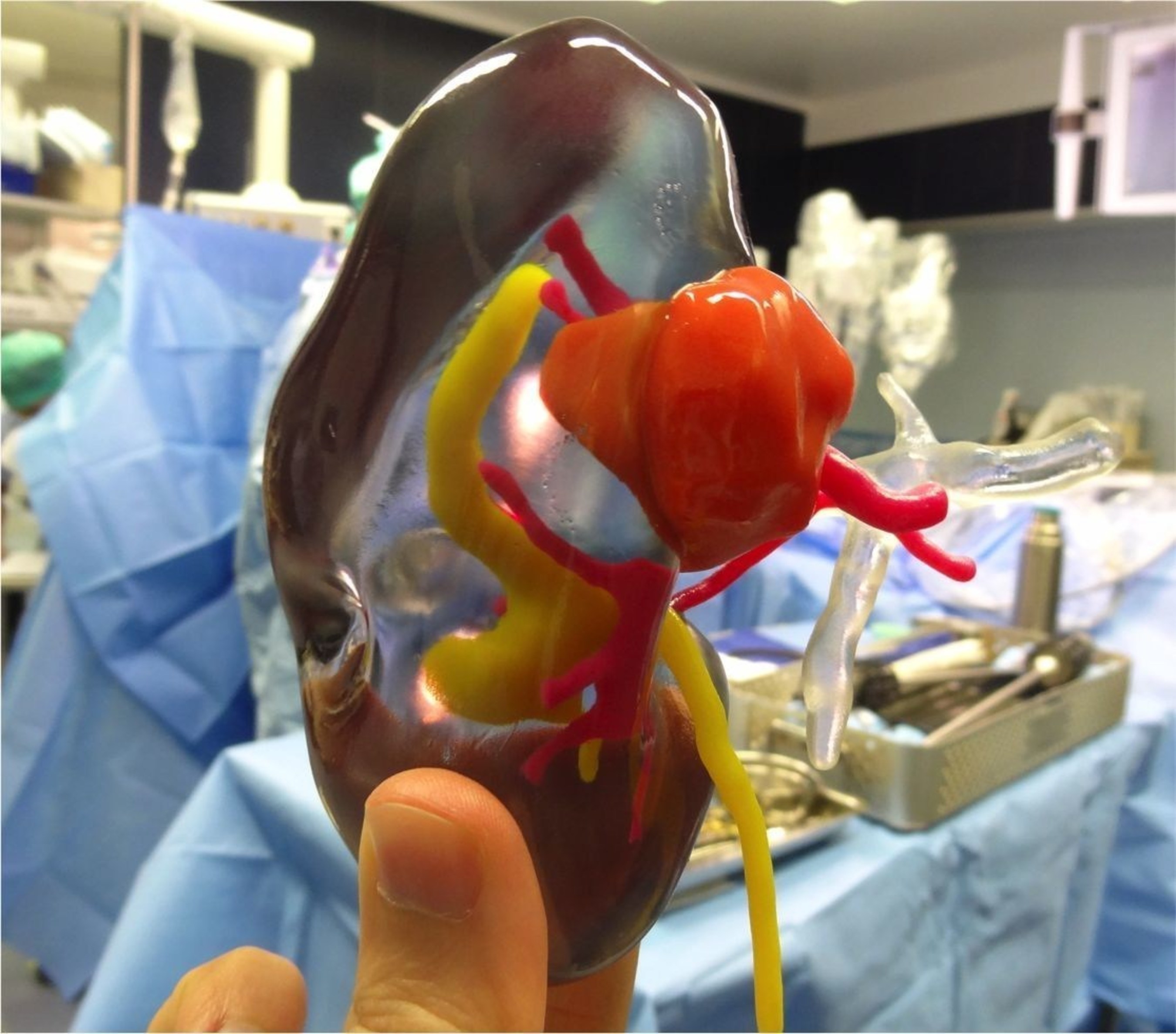 Using Stratasys' transparent VeroClear material enables Dr Bernhard to see inside the kidney and estimate the specific location and depth at which the tumor resides. (PRNewsFoto/Stratasys Ltd) (PRNewsFoto/Stratasys Ltd)
