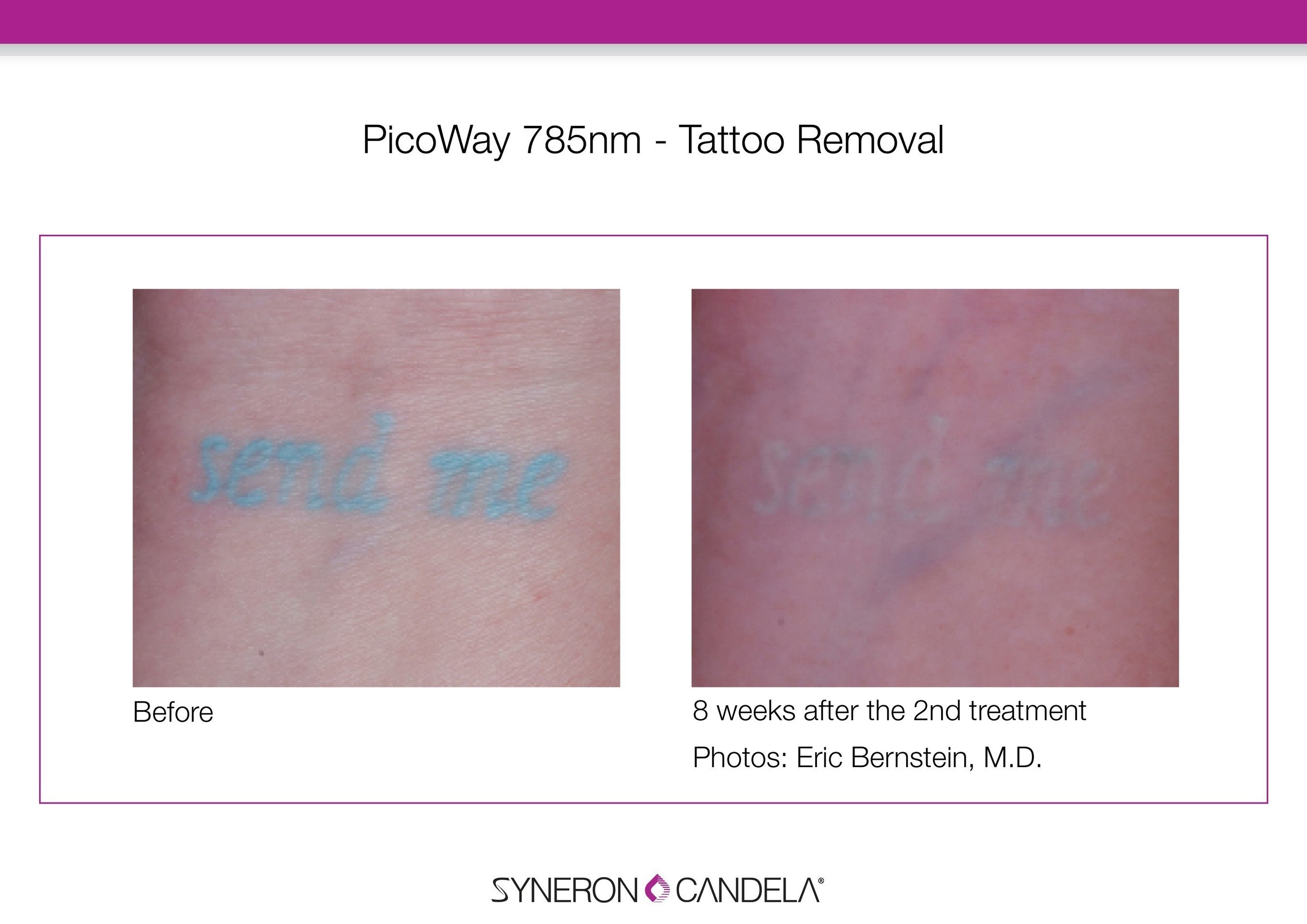 The PicoWay easily removed the green, hard to treat, tattoo ink in just two treatments, providing faster and better results than traditional tattoo removal lasers.