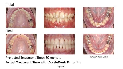 A 26-year-old female, presented with severe anterior crowding, a narrow arch and rotation on tooth #11. Dr. Kenji Ojima's diagnosis and treatment plan revealed that this non-extraction, expansion case was treated with 40 aligners. Standard treatment was projected to be 20 months, but by using AcceleDent, the patient changed trays every five days and treatment was complete in just eight months. (PRNewsFoto/OrthoAccel Technologies, Inc.)