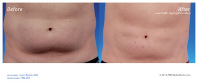Say Goodbye to Unwanted Love Handles: CoolSculpting by ZELTIQ™ Receives FDA Clearance for Patented, Non-Invasive Cooling Treatment for Fat Reduction