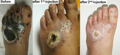 Plantar fasciitis after steroid injection