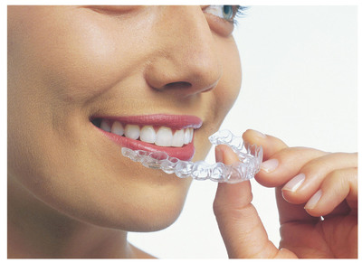 No More Excuses for Crooked Teeth: Invisalign Introduces New "Express" Option to Make Minor Straightening Easier and More Affordable