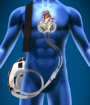 SynCardia Total Artificial Heart Replaces Left Ventricular Assist Devices in 7 Patients