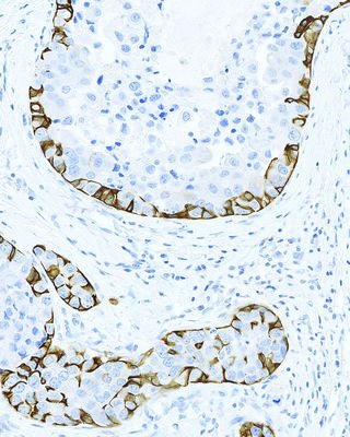 Choose Highly Definitive Antibodies for IHC with the new Leica Biosystems Novocastra HD Menu for Breast Pathology