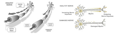 StemGenex™ on Adult Stem Cell-Based Therapy for Multiple Sclerosis