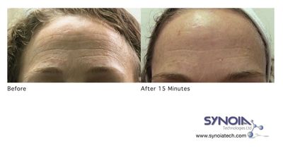 Synoia to Launch New BTX, Collagen and Hyaluronic Infusions for the Revolutionary WISHPro System at CosmoProf Asia, HK 2012