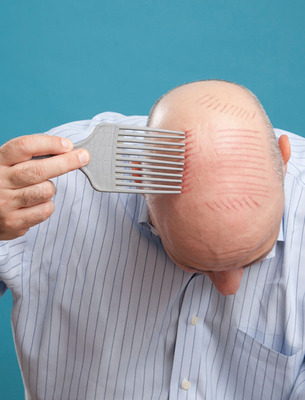 Evolved Bald Man Helps Fellow Sufferers Through the Five Stages of Grieving for Hair Loss