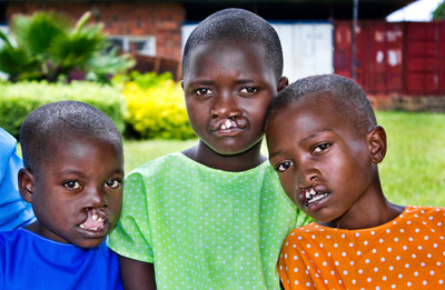 Operation Smile and Smile Train Launch Rwanda Smiles™, An Unprecedented Collaboration to Create a Cleft-Free Rwanda