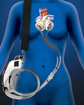 20+ SynCardia Certified Centers to Present Record Number of Total Artificial Heart Abstracts at ISHLT
