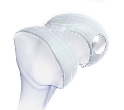 Episurf Medical Receives CE Certification for its Knee Implant and Prepares for Upcoming Product Launch