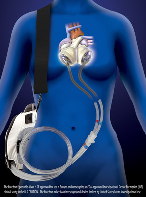 100th SynCardia Total Artificial Heart Implanted in 2013