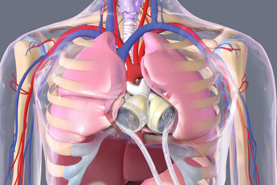 1st Case Report of Using Single-Site Cannulation ECMO to Treat SynCardia Total Artificial Heart Patient Published in Journal of Cardiothoracic Surgery