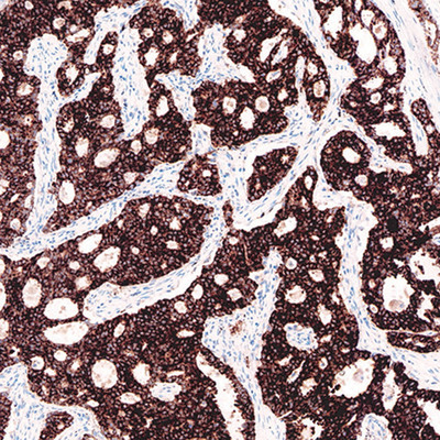 Ventana receives approval from China's FDA for first fully automated IHC companion diagnostic identifying ALK protein expression in lung cancer patients