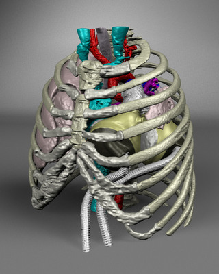 Case Report on 14-Year-Old Pediatric Patient Bridged to Transplant with SynCardia Total Artificial Heart Published in the Journal Perfusion