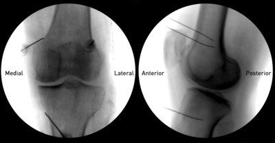 Knee Pain Treatment for Osteoarthritis