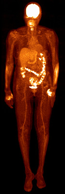 Philips Vereos PET/CT clinical image