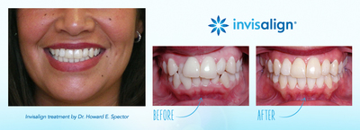 Invisalign treatment by Dr. Howard E. Spector. Treatment duration: 16 months. Disclaimer: The images are presented for reference purposes only and are not intended to represent the actual results a future Invisalign patient will achieve. Treatment times and results will vary by patient.