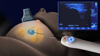 Illustration of IceSense3 Cryoablation System freezing a breast tumor
