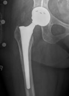 Amidst Reports of Safety Issues Involving Metal-on-Metal Hip Implants, Recipients of DuPuy Hip Implants are Urged to Contact the US Drug Watchdog Immediately