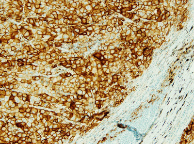 PD-L1 (SP263) Positive. Lung tissue at 20x magnification, stained on a BenchMark ULTRA instrument