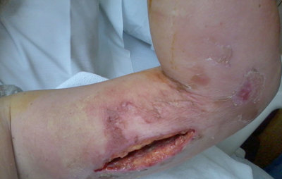 Before treatment - Lori's arm with necrotizing fasciitis