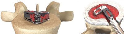 Expanding Orthopedics Inc. has obtained FDA Clearance for its FLXfit™, the world's first 3D expandable interbody cage