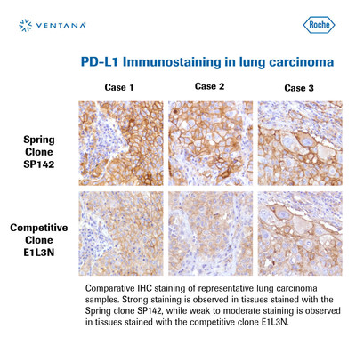 PD-L1 Immunostaining in lung carcinoma. Comparative IHC staining of representative lung carcinoma samples. Strong staining observed in tissues stained with Spring clone SP142, while weak to moderate staining is observed in tissues stained with competitive clone E1L3N.