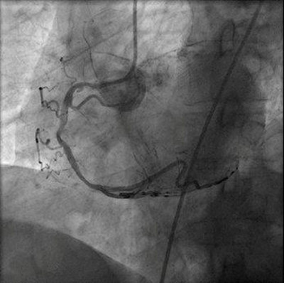 AlluraClarity: Cardiac Angiography performed on AlluraClarity system using 50% less X-ray dose.
