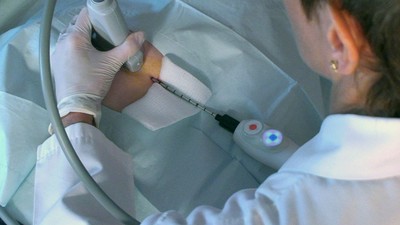 A physician using the IceSense3 Cryoabaltion System to treat breast disease. Cryoablation is technique of using extreme cold to destroy targeted tissue. Treatment of breast tumors in physician office with out surgery.
