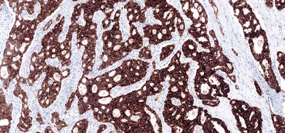 Positive case of lung tissue stained for ALK with VENTANA ALK (D5F3) CDx Assay