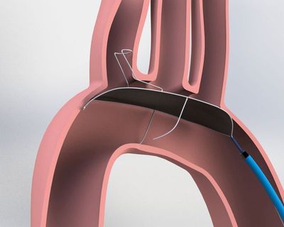 Data Presented at ACC Demonstrates Benefits of Keystone Heart's TriGuard™ Cerebral Protection Device During TAVR