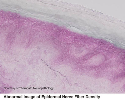 Abnormal Epidermal Nerve Fiber Density