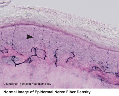 Normal Epidermal Nerve Fiber Density