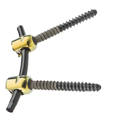 Radiolucent Pedicle Screw System Revolutionizes Care for Cancer Patients