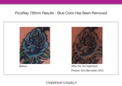 The efficacy and ability of the new 785nm wavelength is shown in this tattoo where the blue and green tattoo inks on the rose and leaves are easily removed in only two treatments.