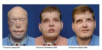 Imagenes que ilustran la notable recuperacion del trasplante de cara realizado por NYU Langone al paciente Patrick Hardison, de agosto de 2014 a agosto de 2016.