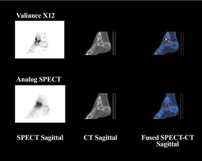 Promising Results From Molecular Dynamics' CZT Based Digital SPECT/CT Trial