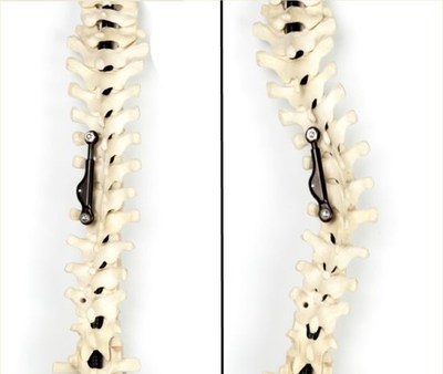 The ApiFix System for scoliosis: after implantation on curvature (at right) and after correction (at left).