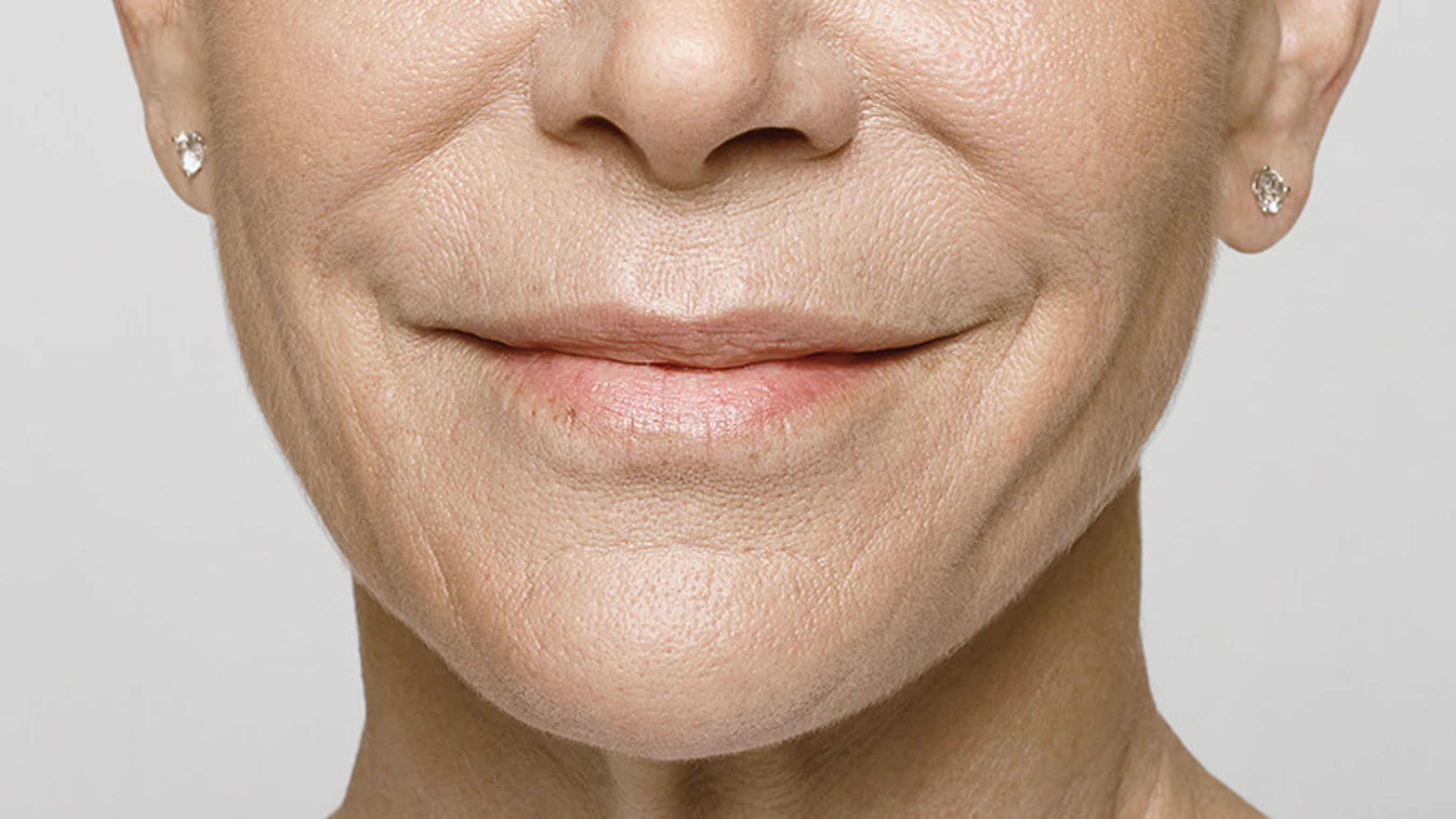 AFTER - 59-year-old patient treated with Restylane(R) Silk and Restylane-L(R). Treatment included: 2.8 ml of Restylane(R) Silk in the lips in perioral lines and 1ml of Restylane-L(R) in the nasolabial folds.
