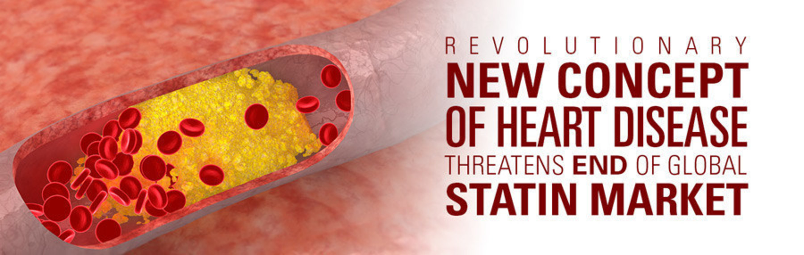 Revolutionary new concept of heart disease threatens end of global statin market